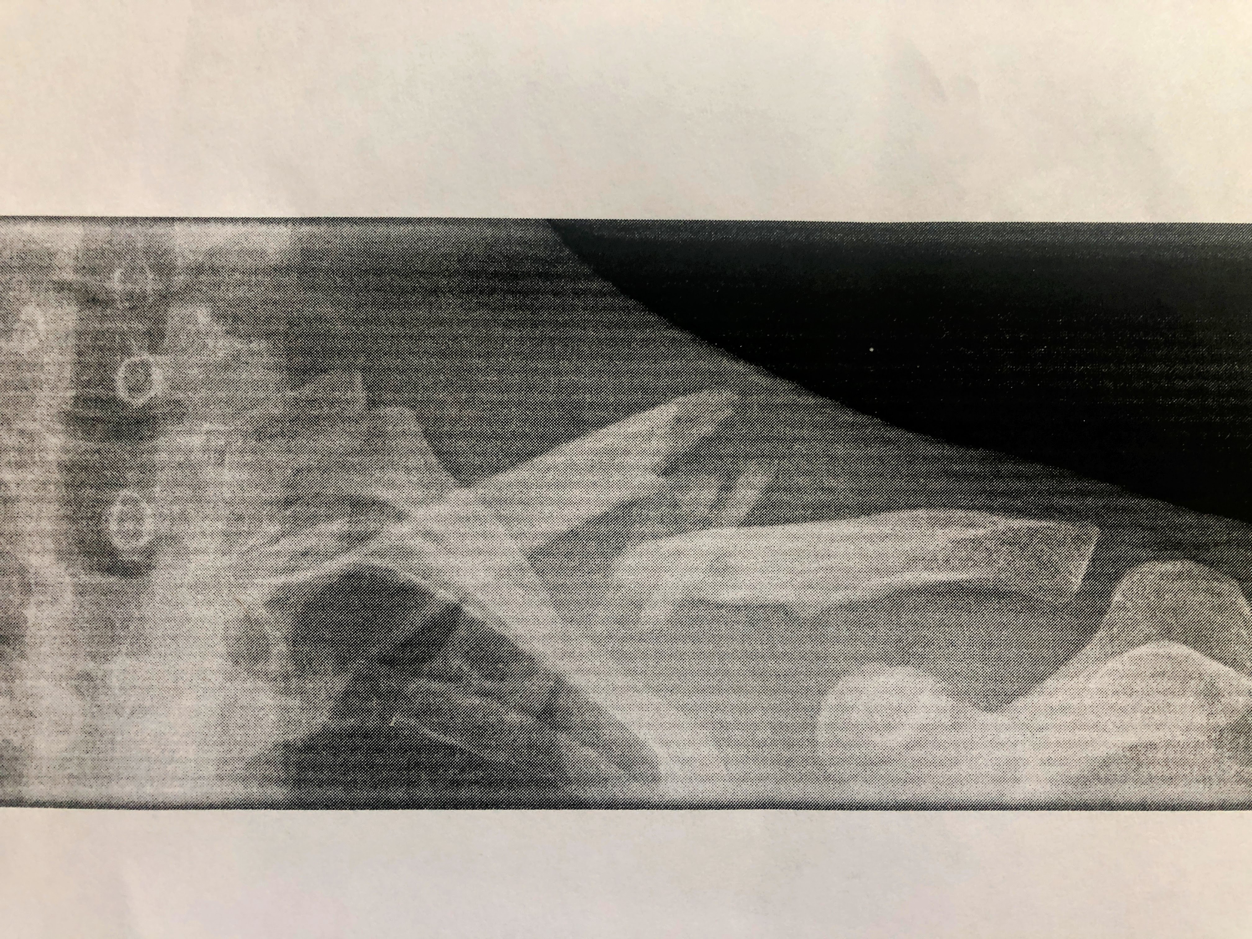 Broken Collarbone