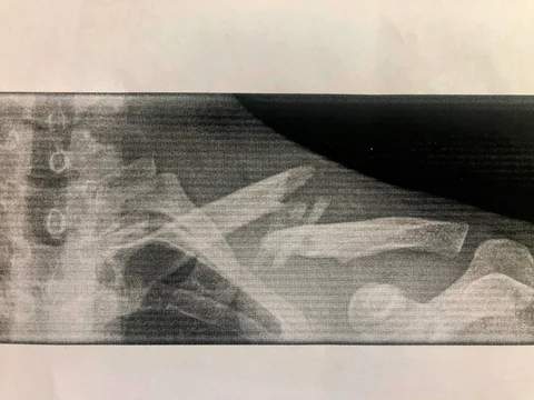Broken Collarbone